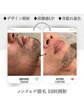 エクラ アン(eclat.un)/４０代男性：ヒゲデザイン照射