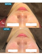 ととのいました。/ハーブピーリング