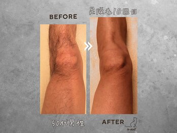 ル シャ/メンズ脱毛/毛穴洗浄/ヘッドスパ