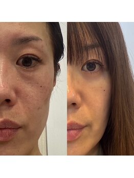 ビーユープロデュースバイエイチ(Be you produced by H)/ビフォーアフター