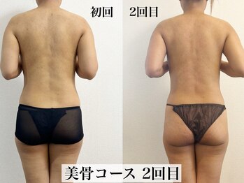 アトレセカンドボディ(Attrait second body)/Before→After【2回目】