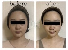 キュープ 下関店(Qpu)/美顔器コース4回での変化