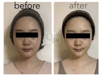 キュープ 下関店(Qpu)/美顔器コース4回での変化