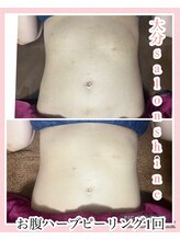 サロンシャイン(Salon Shine)/お腹のハーブピーリング1回