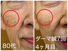 皇漢堂鍼灸療院/最新美容鍼【ダーマ鍼】での変化