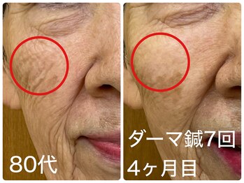 皇漢堂鍼灸療院/最新美容鍼【ダーマ鍼】での変化