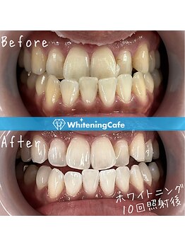 ホワイトニングカフェ 和歌山ガーデンパーク店(WhiteningCafe)/16分×2回照射/5回来店/30代男性