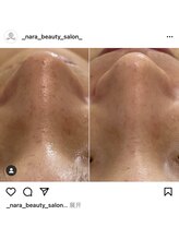 ナラビューティー(NARA BEAUTY)/ハイドラフェイシャル写真