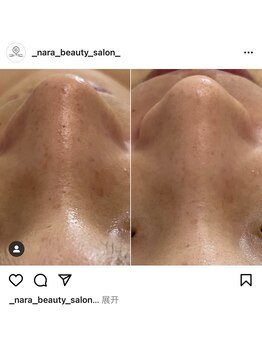 ナラビューティー(NARA BEAUTY)/ハイドラフェイシャル写真