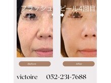 ヴィクトワール(Victoire)/某美容外科の半額でできます