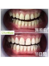 ルブラン 奈良店(Le Blanc)/11日間で白く！！