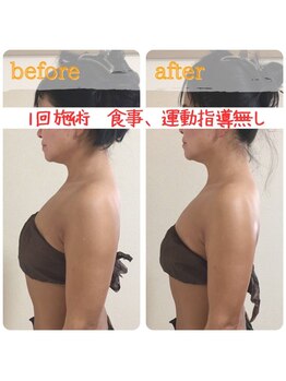 ティアラ/before after　[デトリム]