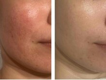 アドビューティ(Add Beauty)/≪プラズマフェイシャル≫