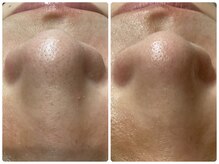 ヒスイ バイ アメイジング(Hisui by AMAZING)/3D 毛穴洗浄 韓国式 毛穴ケア