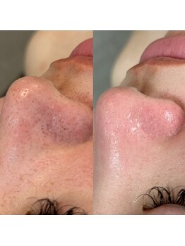 シェリー トウキョウ 西葛西店(Cherie Tokyo)/黒ずみ毛穴→引き締まった毛穴◎