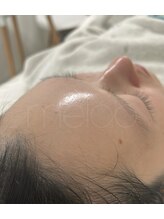 黒ずみ毛穴ケア専門店　melab　【ミラボ】〈毛穴エクストラクション/毛穴ケア〉/韓国ピーリング(プラピール)