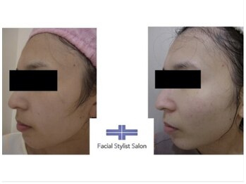 フェイシャルスタイリストサロン 四谷店/ケア例(53)