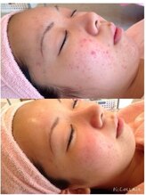 エピシア(EPICIA)/ハーブピーリング肌荒れ改善も◎