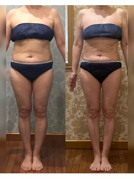 ヴィクトワール シュエット/【痩身】50代のお客様の変化