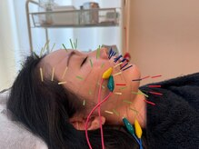 二子新地整骨院鍼灸マッサージ院/美容鍼＋EMSで肌質改善！