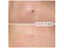 シミケアし放題☆画像のようなシミの改善実績◎