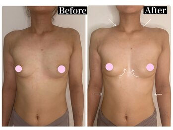 ハーズプラス(hers+)/1回でもバストの形が変わる!