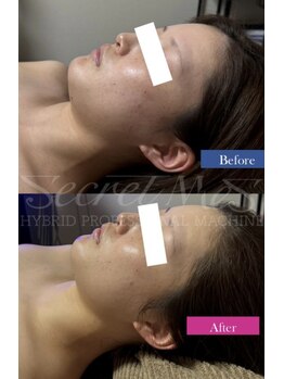 ユフラ(Juhla)/【切らない小顔リフト】