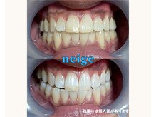 ネージュ(neige)の雰囲気(お客様のBefore→After写真☆通う頻度に比例して確実に白くなる)