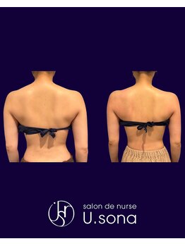 小顔・脂肪コントロール専門 salon de nurse U.sona～松本店～/【ブライダル】脂肪分解症例