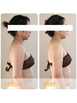 ティアラ/before after　[デトリム]