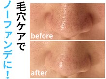 エリン(ERIN)/毛穴徹底洗浄