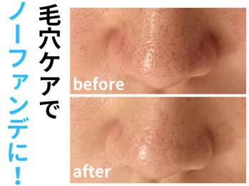 エリン(ERIN)/毛穴徹底洗浄