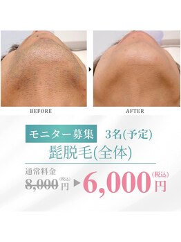 シーライン(Cline)/髭脱毛のモニター様募集中