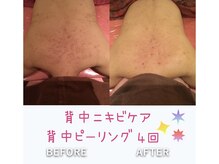 ビューティースパ/ぶつぶつザラザラ汚背中卒業★