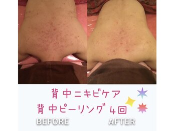 ビューティースパ/ぶつぶつザラザラ汚背中卒業★