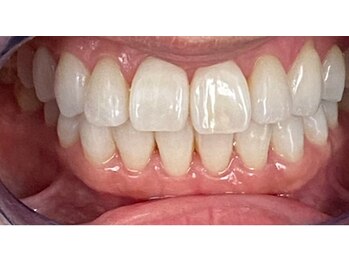 コントレール 歯ぁと(CONTRAIL)の写真/無資格者のホワイトニングとは違います！しっかりとお口の状態を把握し、＋αのアドバイスと施術をします。