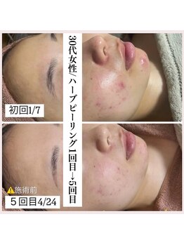 ホワイトアクア 福岡天神店(WHITE AQUA)/30代女性/ハーブピーリング