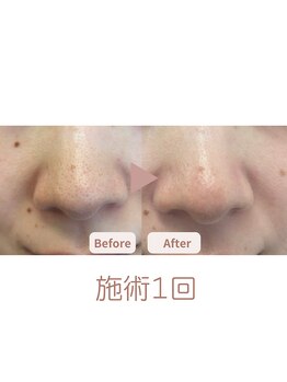 クレン(CLEN)/毛穴洗浄/ブライダル/美白