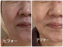 ノーブル シャット Noble Chate/生き生きとした肌は何回目？