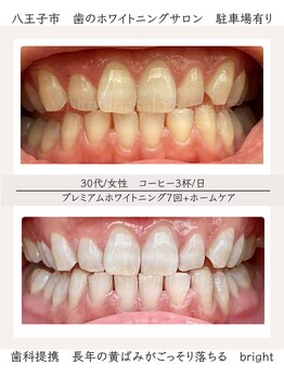 ブライト 八王子(bright)/30代女性/八王子ホワイトニング