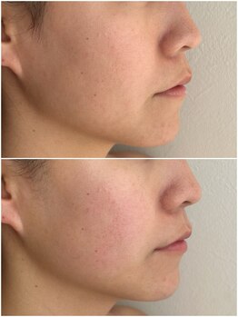 ルアンビューティー メディカルプラス(Luan beauty MEDICAL+)/チタニウムリフト×1回