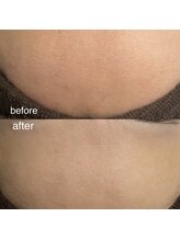 シエル(Ciel)/フェイシャル★毛穴改善