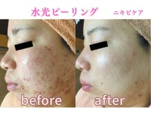 ミレット(Miretto)/【ニキビ改善】水光ピーリング