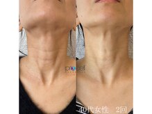 オウジエステサロン(OJIエステサロン)/40代女性　プロセル2回