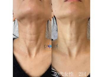 オウジエステサロン(OJIエステサロン)/40代女性　プロセル2回