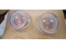 ままの森鍼灸マッサージ院/吸い玉（カッピング）