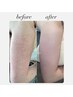 人気No. 3二の腕ぷつぷつざらつき卒業/二の腕ハーブピーリングケア¥27000→
