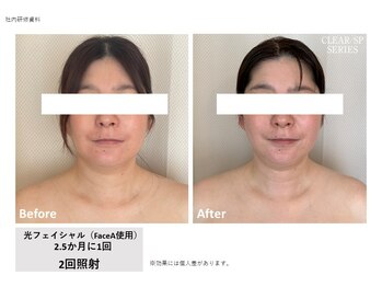 レクリエイター(Re:QREATOR)/セルフ脱毛(before after)