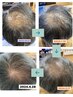 【男性用】生え際の抜け毛細毛に/毛根幹細胞活性育毛促進プログラム初回体験
