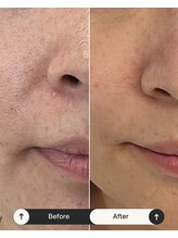 マヴィ 高槻店(MavY.)/頬の開き毛穴お悩みの方